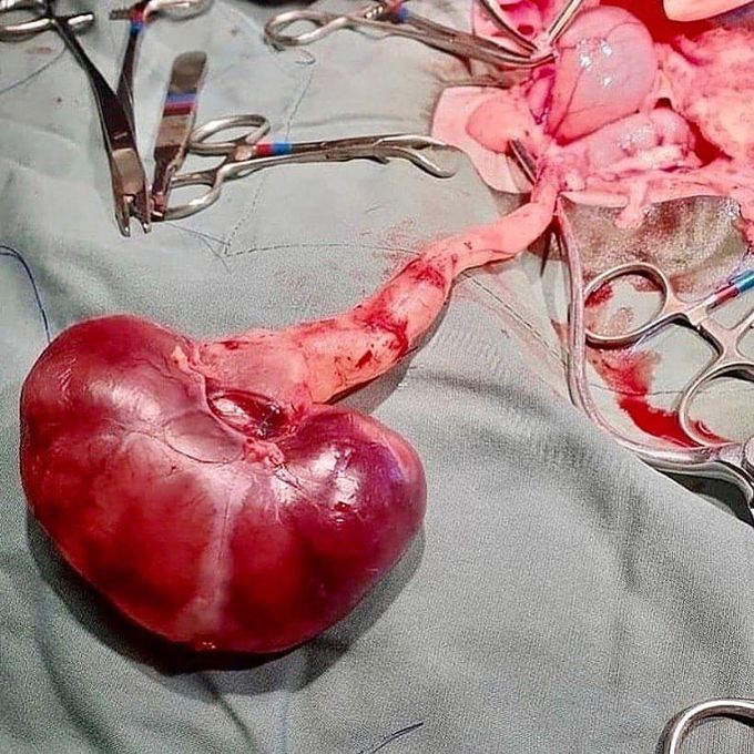 Surgical removal of kidney (Nephrectomy) following Chronic kidney disease! 