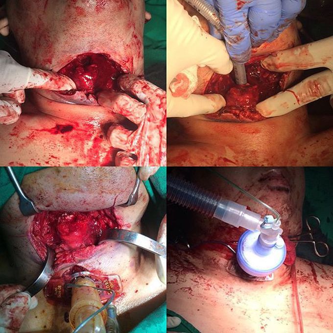 Another tracheal injury...slash wound on suicidal attempt... 
