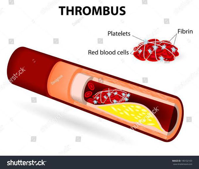 Causes of thrombosis