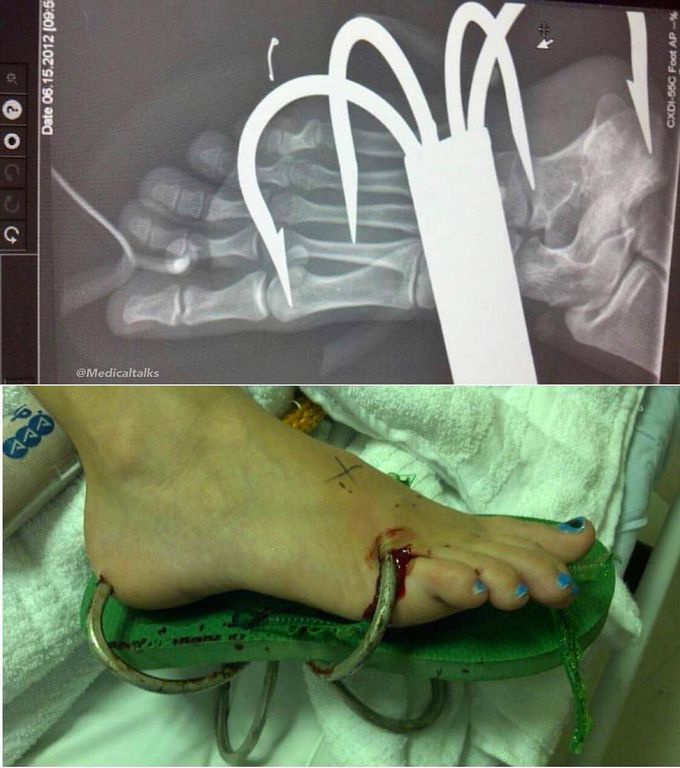 Teenage girl tripped over the biggest shark hook!! 