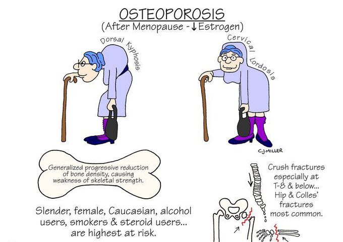 Osteoporosis