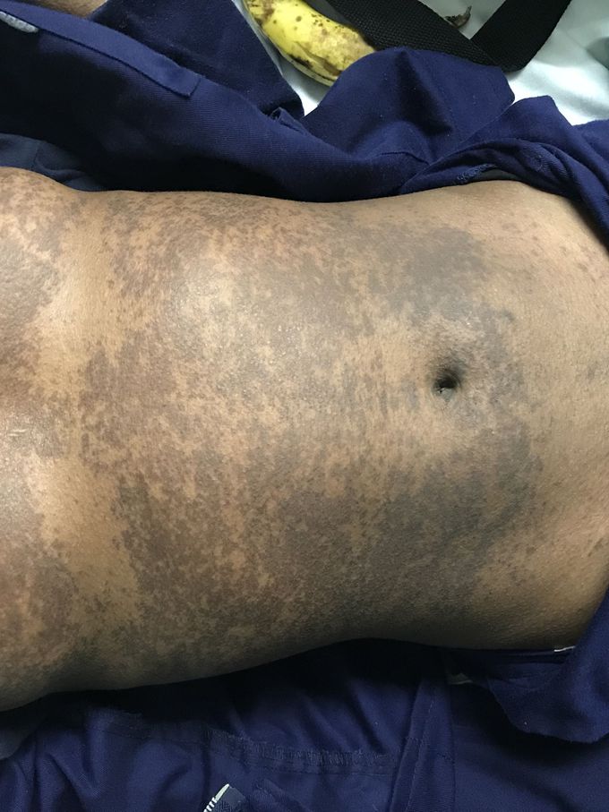 What’s the diagnosis? (Answer to be revealed)