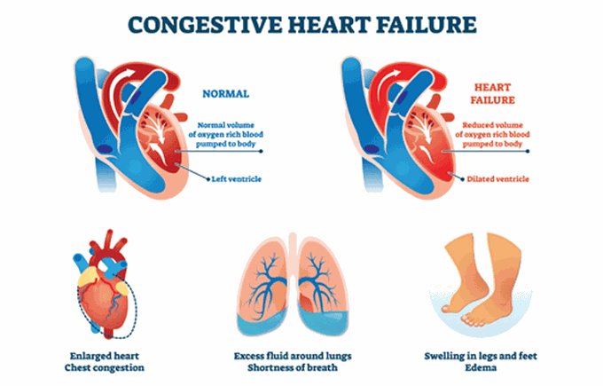 Causes of congestive heart failure