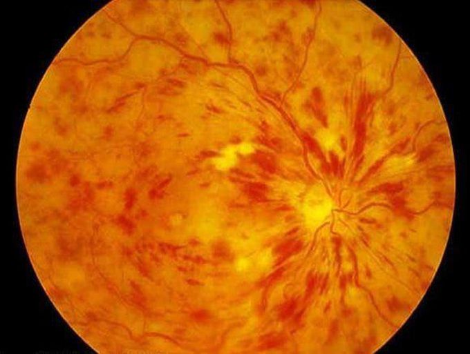 Ophthalmoscopy