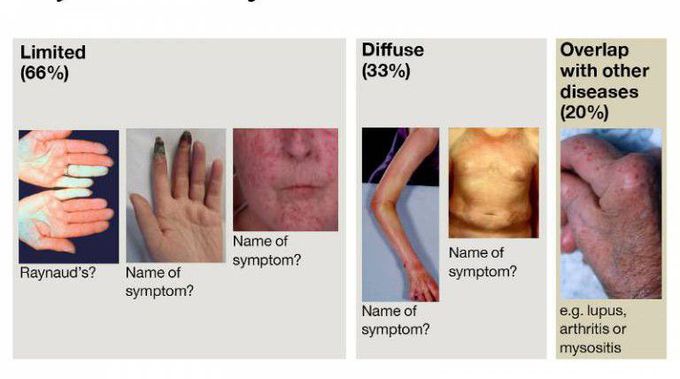 Cause of systemic sclerosis