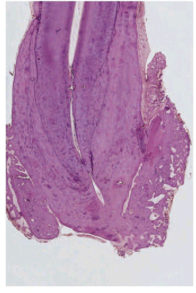 Hypercementosis in Paget’s disease.