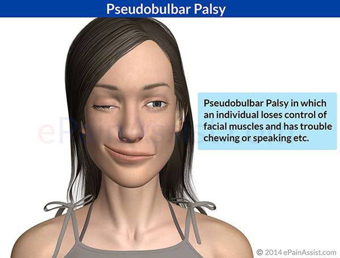 Pseudobulbar palsy