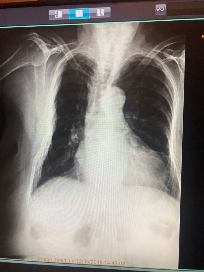 Pt complains of pain in right ribs, shortness of breath, and pain when standing