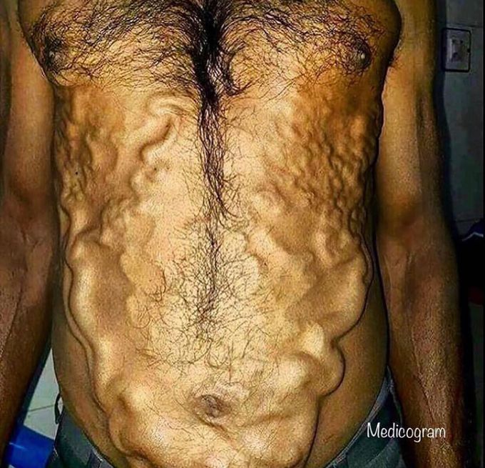 Caput medusae: 
