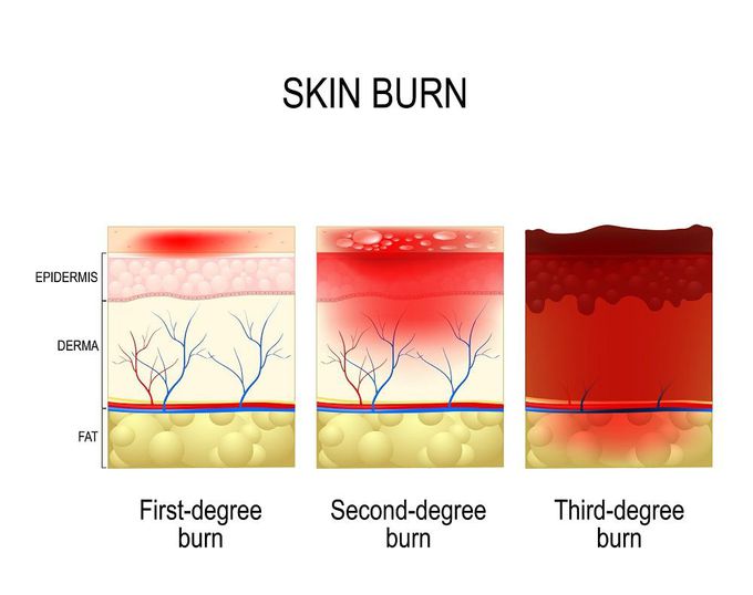 Types of Sunburn