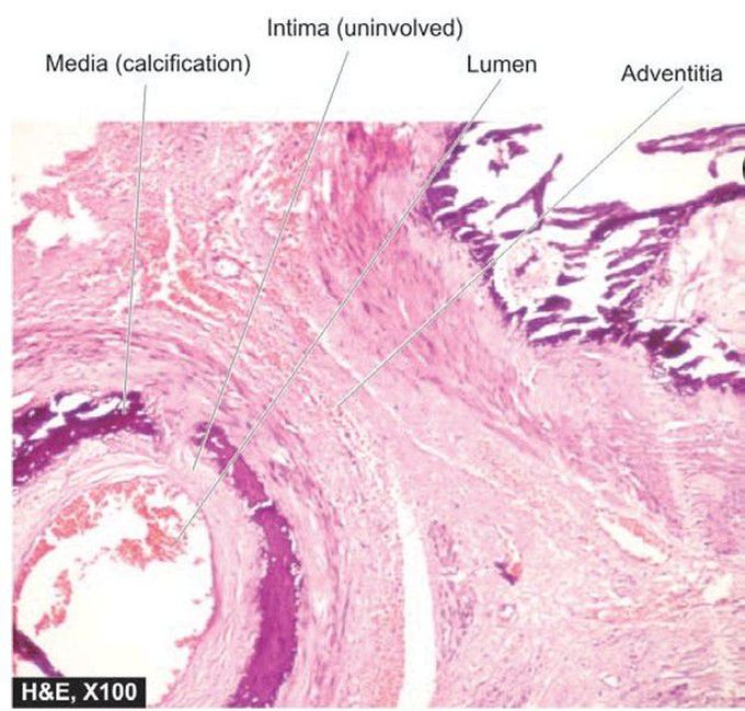 Medial calcific sclerosis