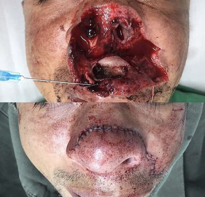 nose broke