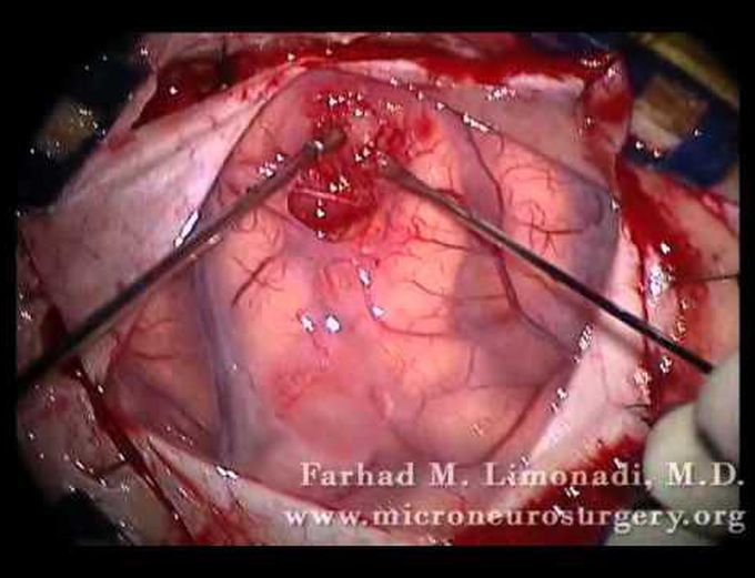 Left Fronto-parietal Craniotomy for resection of glioblastoma multiforme