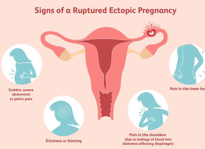 Symptoms of ectopic pregnancy