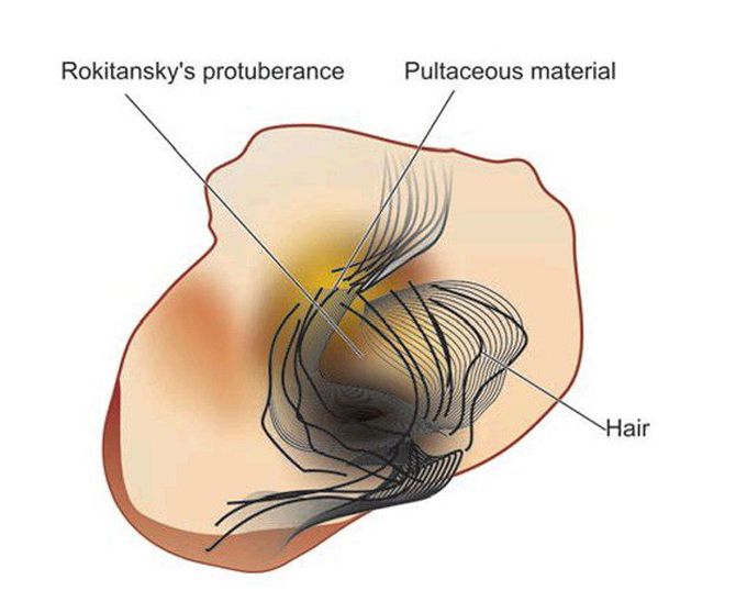 Dermoid cyst of the ovary