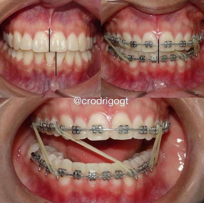 The Intermaxillary Elastics