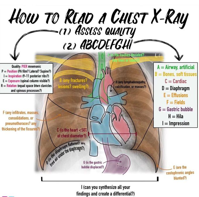 How to Read the Chest Xray