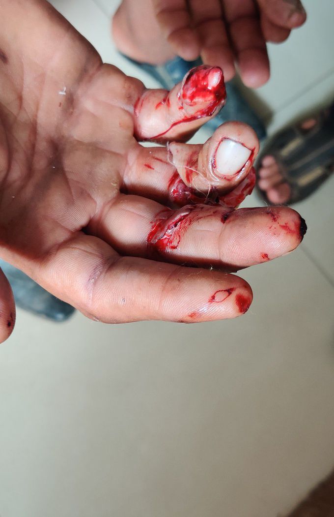 Traumatic Hand Injury