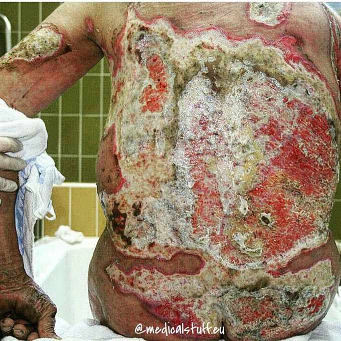 Massive burns caused by a burst of flame