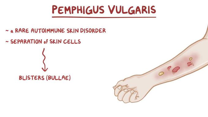 Causes of pemphigus vulgaris