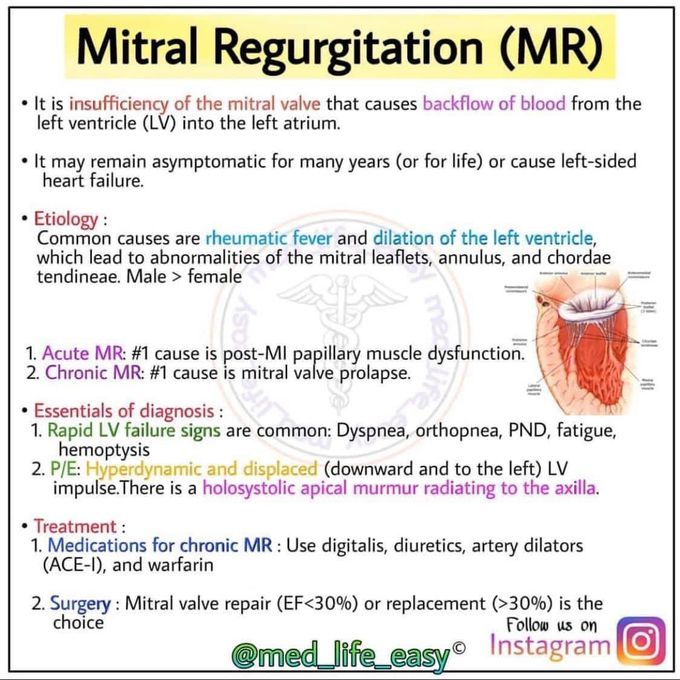 Mitral regurgitation