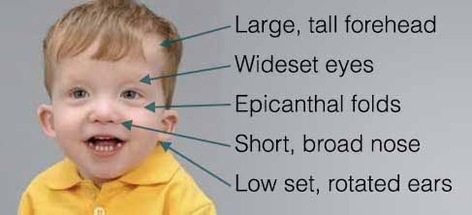 Causes of noonan syndrome - MEDizzy