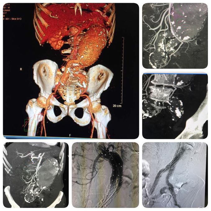 Big Abdominal Aortic Aneurysm n short iliac aneurysm with tortuous neck.