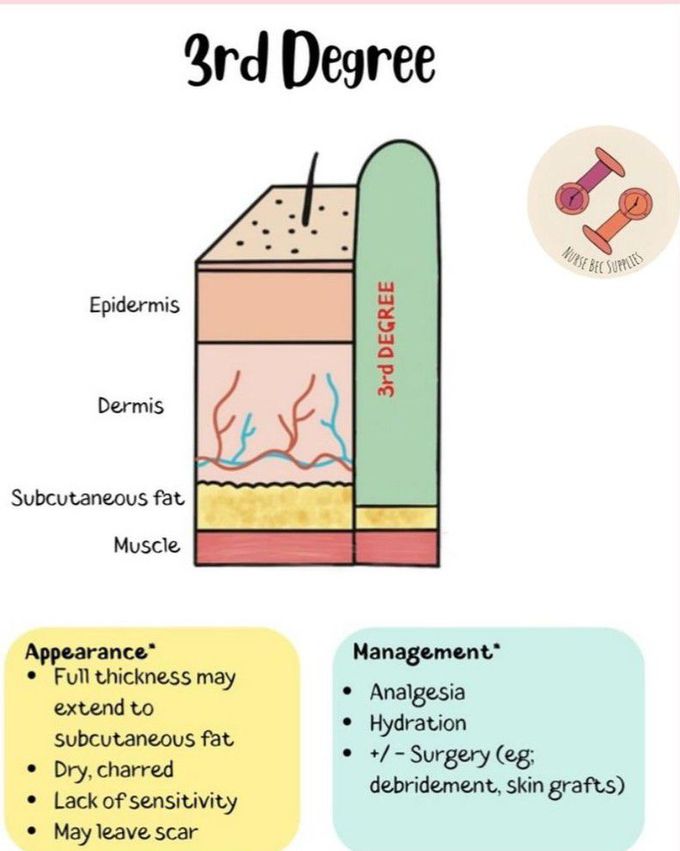 3rd Degree Burn