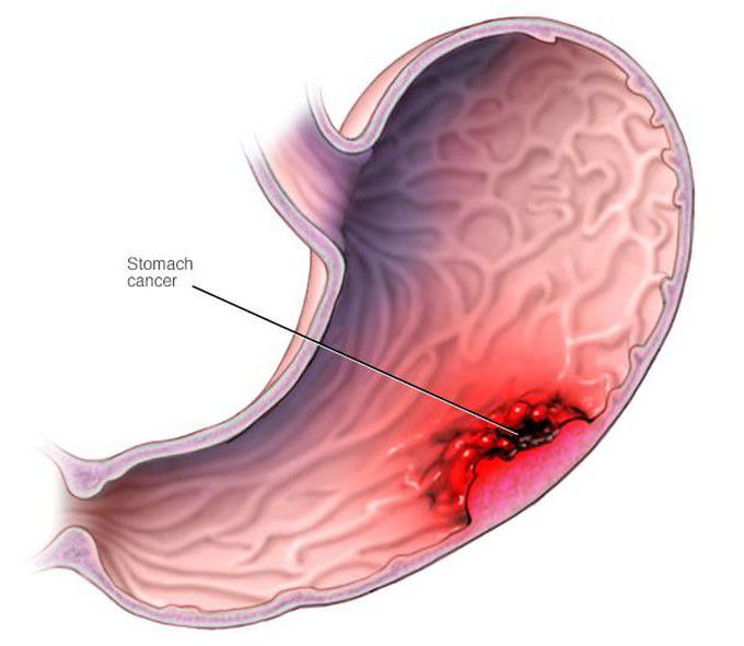 Gastric Carcinoma