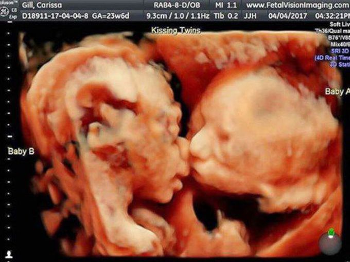 Kissing twins