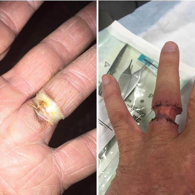 Ring got in contact with a car battery, causing circumferential burn to the fourth finger! 💍