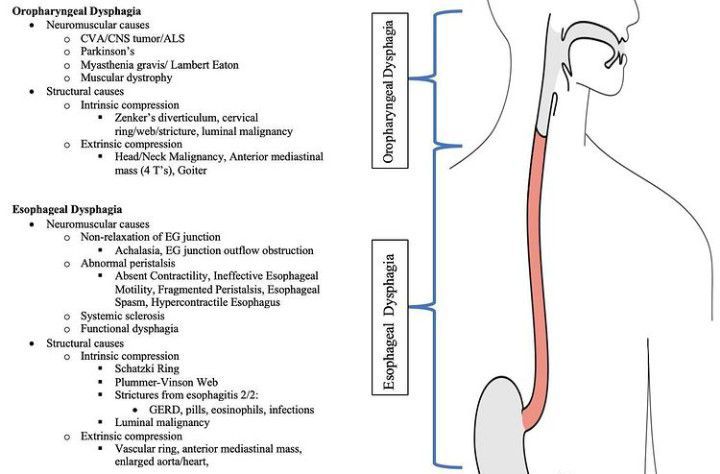 Causes Of Dysphagia - MEDizzy