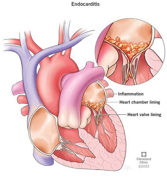 Endocarditis Treatment MEDizzy