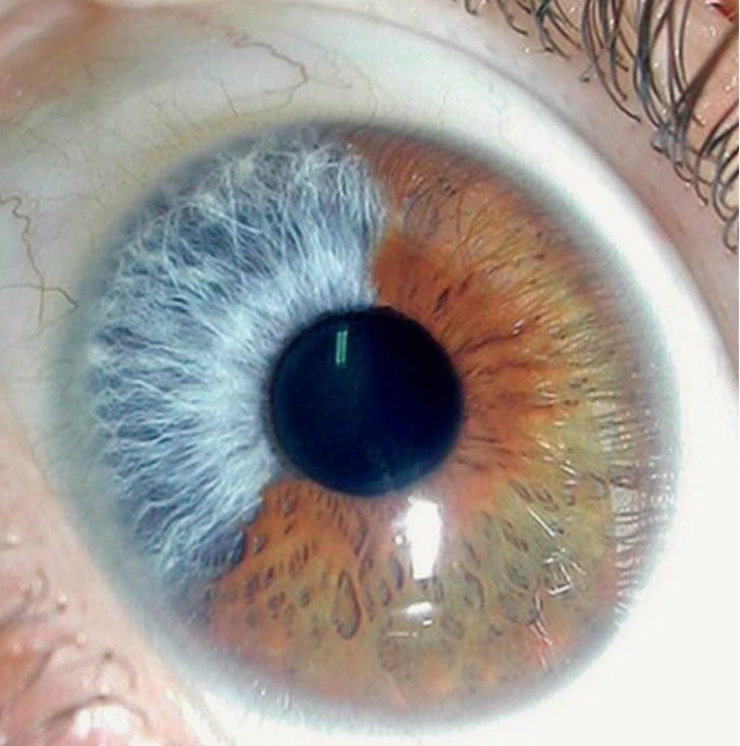 Partial heterochromia of Iris