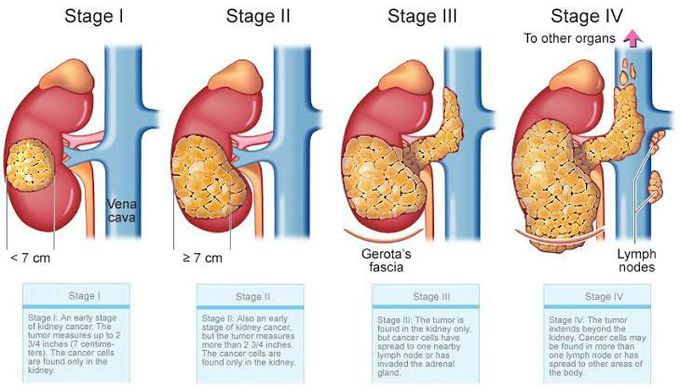 Wilms tumor