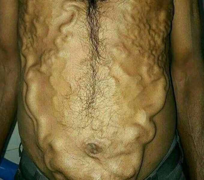 Severe case of Caput medusae