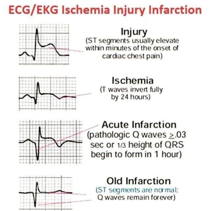 ECG Changes