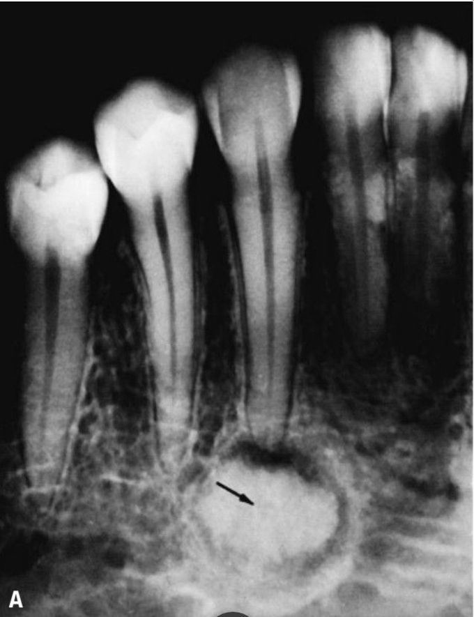 Periapical cementoma