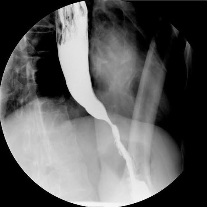 Treatment of achalasia