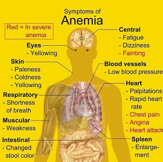 Anemia