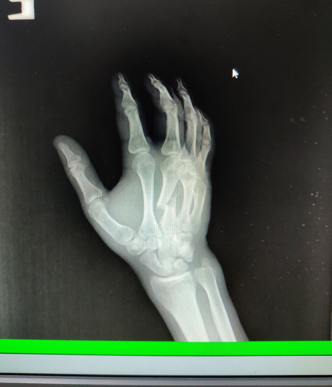 Patient was cooking beef, poked his arm with a knife