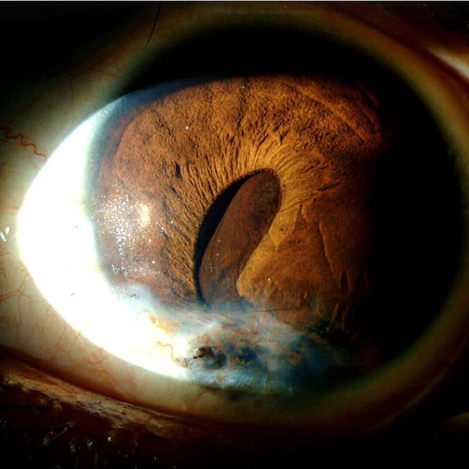 Ever wondered what a torn iris looked like?