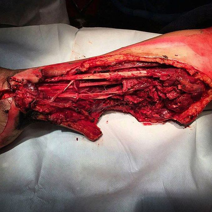 Severe injury to the arm