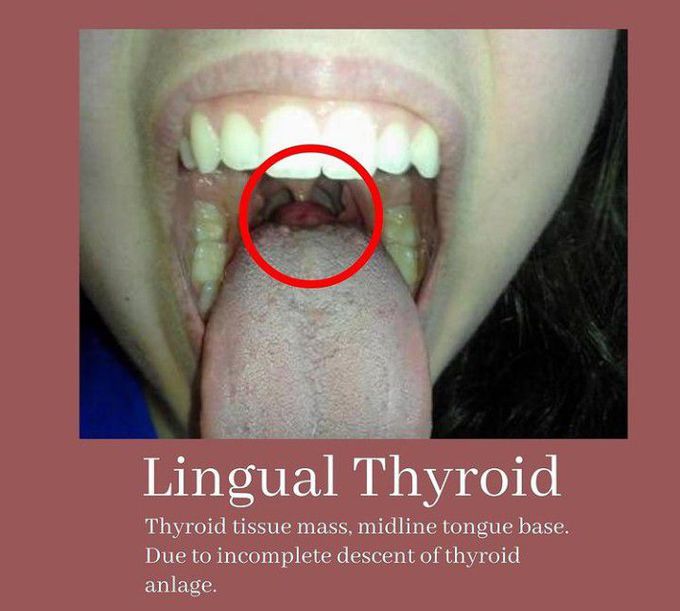 Lingual Thyroid