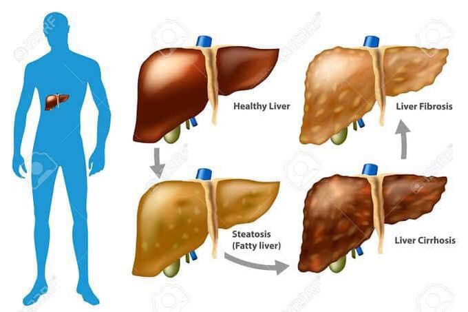 Cirrhosis