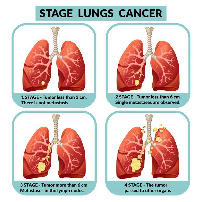 Stage 4 Small Cell Lung Cancer Symptoms