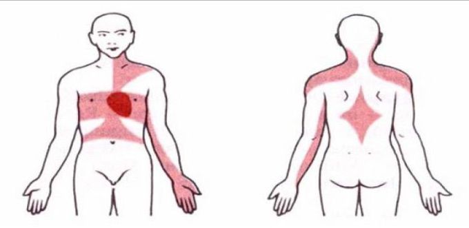 Angina pectoris göğüste her iki tarafta omuzlarda kollarda ağrı