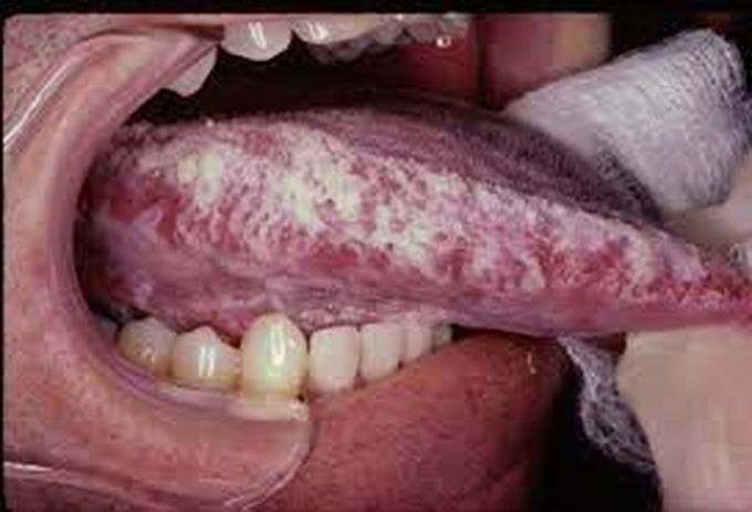 Oral hairy leukoplakia
