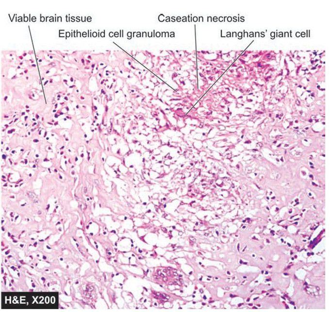 Tuberculous encephalitis of the brain.