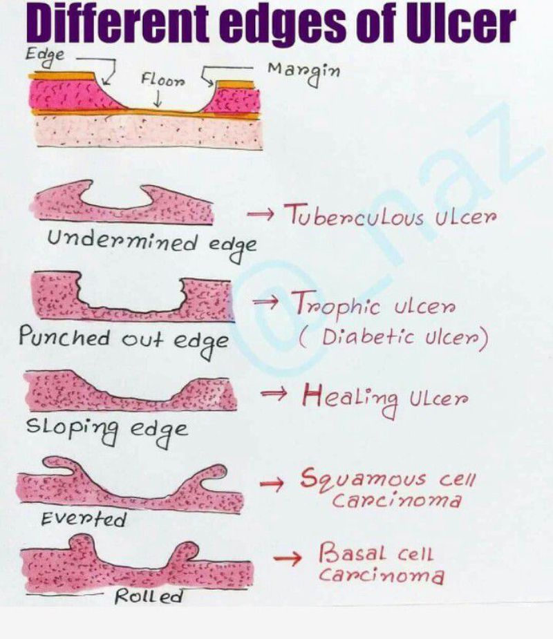 Edges of ulcer MEDizzy